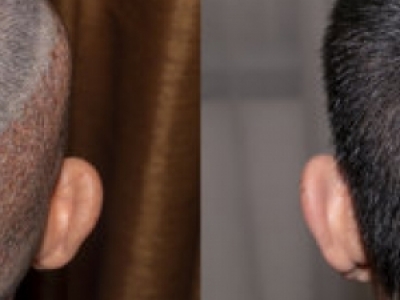 植發(fā)1600毛囊價(jià)錢 植發(fā)價(jià)格范圍參考