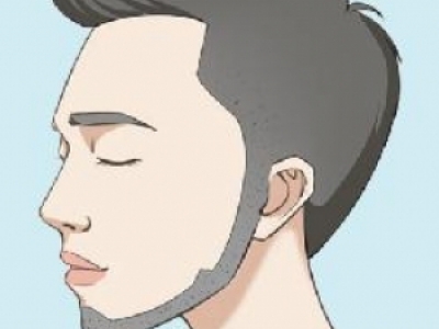 做鬢角移植不適應(yīng)人群有哪些 需要了解這些注意事項(xiàng)